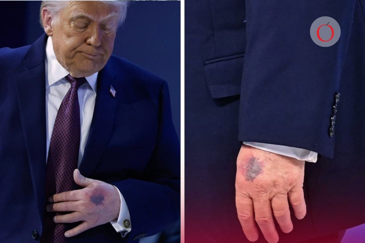 El misterio detrás del golpe cerebral del líder estadounidense: ¿qué revelan las primeras informaciones sobre la salud del presidente Trump?